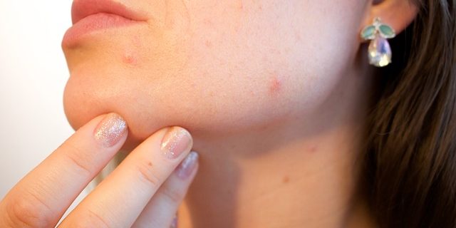 acne-1606765_640