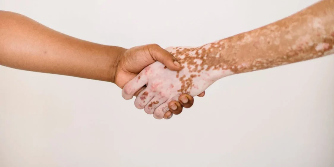 vitiligo