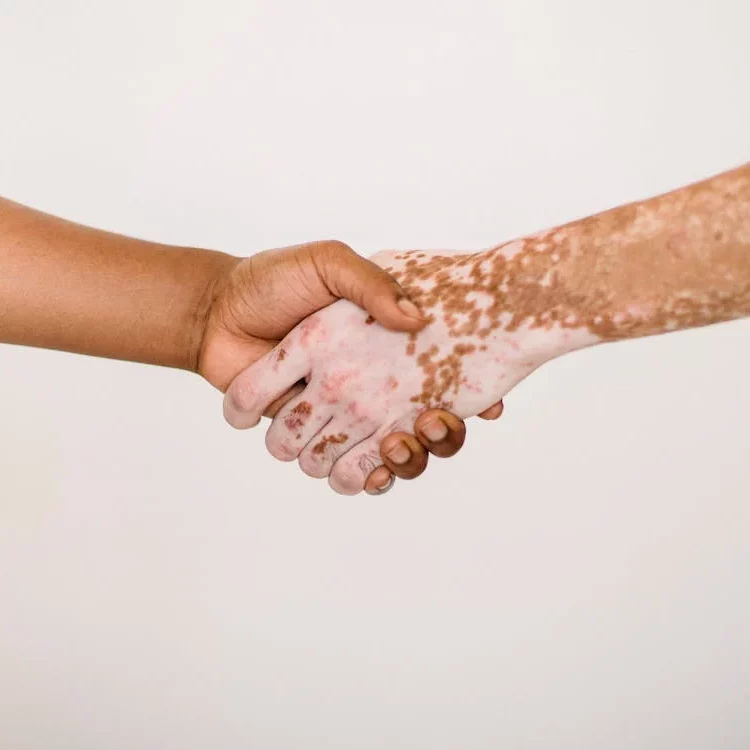 vitiligo